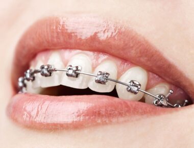 Metal-braces