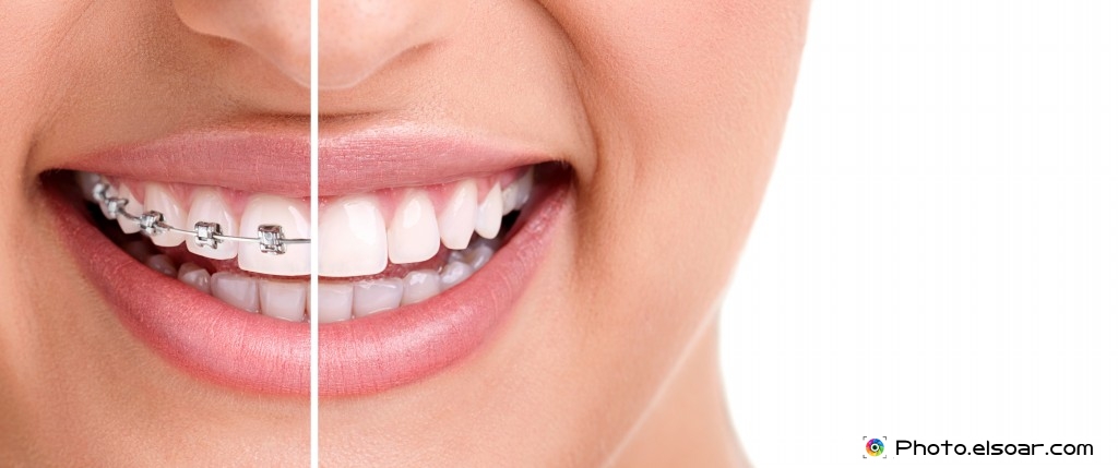 Healthy-Smile-With-Braces