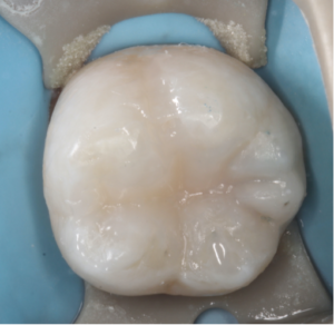 Risin Post Treatment