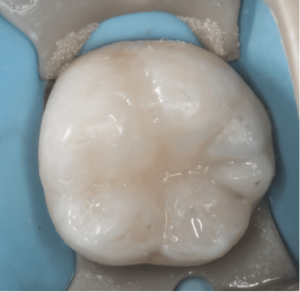 Risin Post Treatment