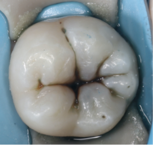 Risin Pre treatment