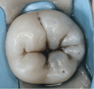 Risin Pre treatment
