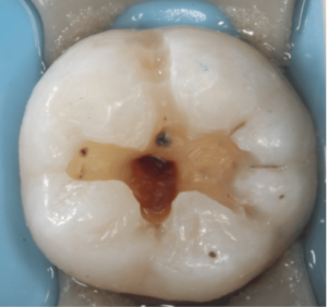 Risin Treatment 1