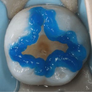 Risin Treatment 2