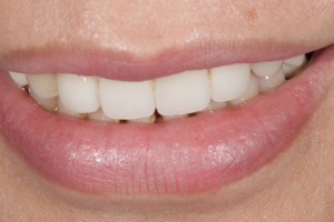 Veneer post treatment 2