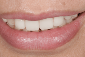 Veneer post treatment 2