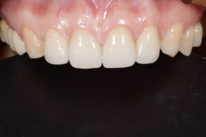 Veneer post treatment