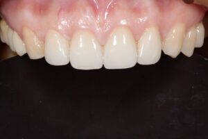Veneer post treatment