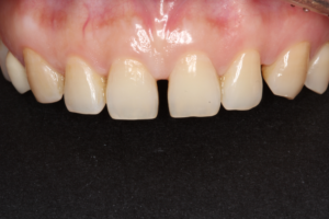 Veneer pre treatment