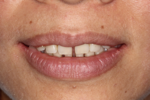 Veneer pre treatment 2