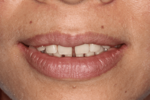 Veneer pre treatment 2