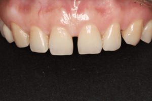 Veneer pre treatment