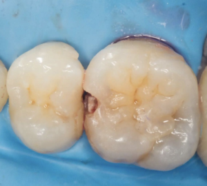 caries1 caries1