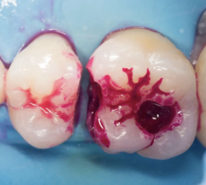 caries2 caries2