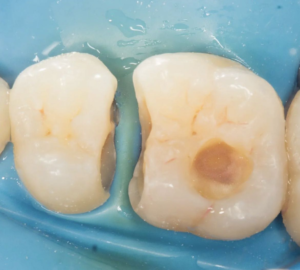 caries3 caries3