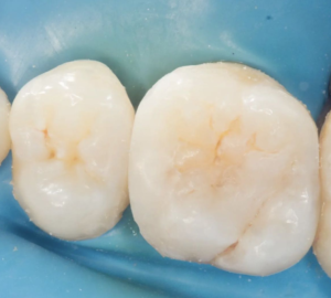 caries4 caries4